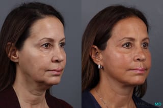 Before and after Blepharoplasty case 7096 - Angle 2