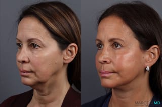 Before and after Blepharoplasty case 7096 - Angle 4