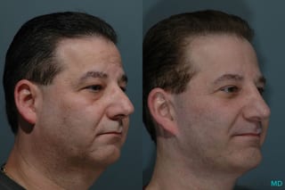 Before and after Facelift & Neck Lift case 7108 - Angle 2
