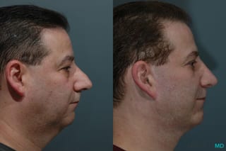 Before and after Facelift & Neck Lift case 7108 - Angle 3