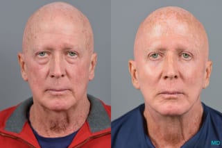 Before and after Blepharoplasty Lower case 7110 - Angle 1