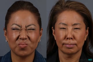 Before and after Botox - Glabella case 7143 - Angle 2