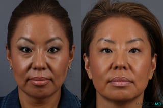 Before and after Botox - Crow's Feet case 7144 - Angle 1