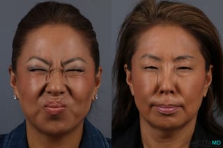Before and after Botox - Crow's Feet case 7144 - Angle 2