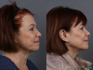 Before and after Botox - DAO case 7148 - Angle 4