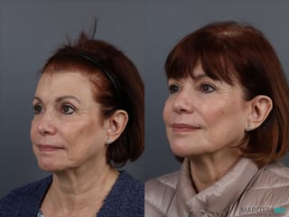 Before and after Botox - DAO case 7148 - Angle 5