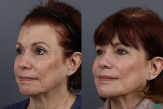 Before and after Botox - Chin case 7149 - Angle 5