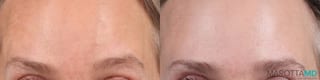 Before and after Botox - Forehead case 7170 - Angle 2