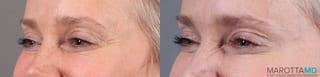 Before and after Botox - Glabella case 7171 - Angle 3