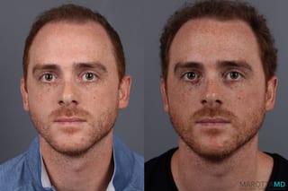 Before and after PRP Scalp Treatment case 7172 - Angle 1