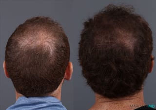 Before and after PRP Scalp Treatment case 7172 - Angle 2