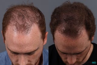 Before and after PRP Scalp Treatment case 7172 - Angle 3