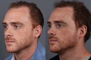 Before and after PRP Scalp Treatment case 7172 - Angle 4