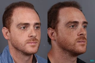 Before and after PRP Scalp Treatment case 7172 - Angle 5