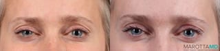 Before and after Botox - Crow's Feet case 7173 - Angle 1