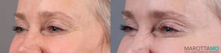 Before and after Botox - Crow's Feet case 7173 - Angle 3