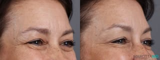 Before and after Botox - Forehead case 7180 - Angle 3