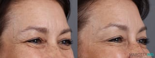 Before and after Botox - Glabella case 7182 - Angle 3