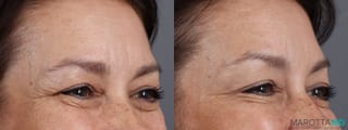 Before and after Botox - Crow's Feet case 7183 - Angle 3