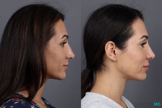 Before and after Botox - Crow's Feet case 7192 - Angle 3