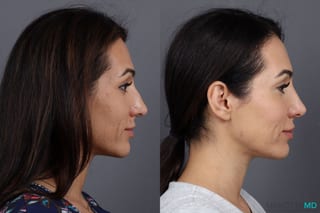 Before and after Botox - Glabella case 7193 - Angle 3
