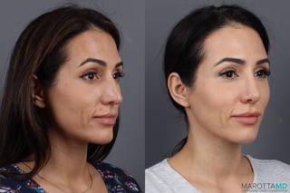 Before and after Botox - Crow's Feet case 7194 - Angle 2