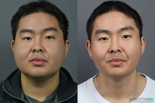 Before and after Buccal Fat Removal case 7220 - Angle 1