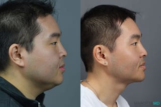 Before and after Buccal Fat Removal case 7220 - Angle 2