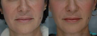 Before and after Ultherapy® case 7235 - Angle 1