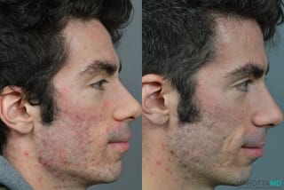 Before and after Genius Radio Frequency Microneedling case 7238 - Angle 2