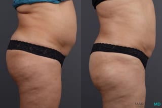 Before and after EMSCULPT® case 7247 - Angle 1