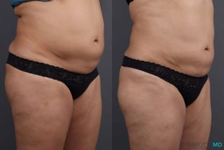Before and after EMSCULPT® case 7247 - Angle 2
