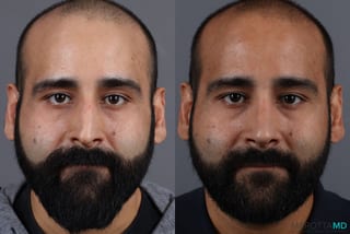 Before and after Male Rhinoplasty case 7261 - Angle 1