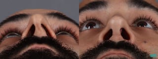 Before and after Male Rhinoplasty case 7261 - Angle 6