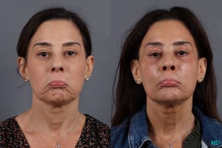 Before and after BOTOX® Cosmetic case 7267 - Angle 2