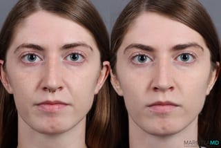 Before and after Juvederm / Fillers case 7269 - Angle 1