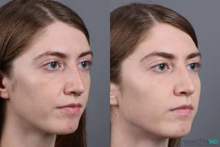 Before and after Juvederm / Fillers case 7269 - Angle 3