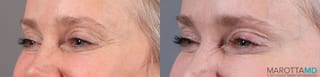 Before and after BOTOX® Cosmetic case 7271 - Angle 3