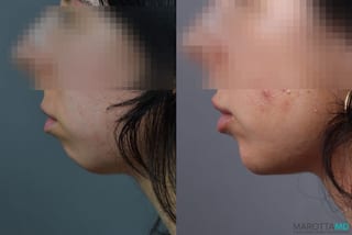 Before and after Filler - Chin case 7276 - Angle 1