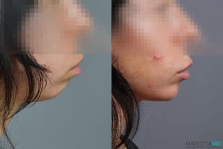 Before and after Filler - Chin case 7276 - Angle 2