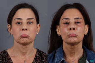 Before and after Botox - Chin case 7292 - Angle 2