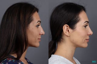 Before and after BOTOX® Cosmetic case 7298 - Angle 3
