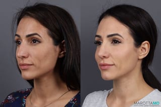 Before and after SkinVive case 7301 - Angle 4
