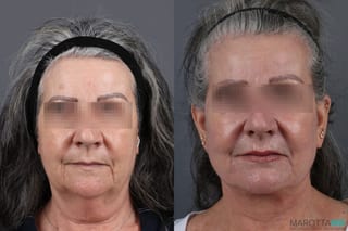 Before and after Laser Skin Resurfacing - Face case 7310 - Angle 1