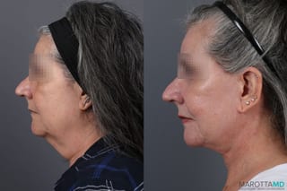 Before and after Laser Skin Resurfacing - Face case 7310 - Angle 4