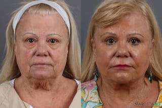 Before and after Laser Skin Resurfacing - Face case 7312 - Angle 1