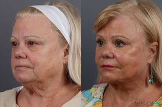 Before and after Laser Skin Resurfacing - Face case 7312 - Angle 4