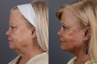 Before and after Laser Skin Resurfacing - Face case 7312 - Angle 5