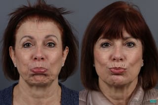 Before and after BOTOX® Cosmetic case 7314 - Angle 2