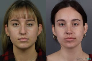 Before and after Rhinoplasty case 12317 - Angle 1